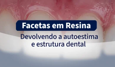 Facetas Diretas de Resina: Solução Estética Rápida e Longeva (Relato de Caso)